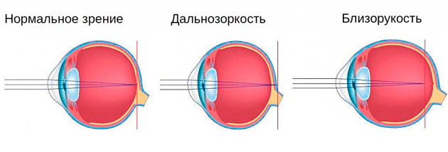 Строение глаза при близорукости и дальнозоркости